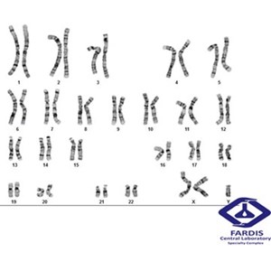 سندروم کلاین فرتر